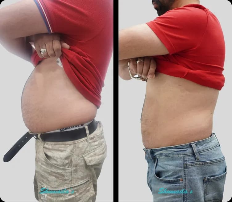 Weight Loss Injections