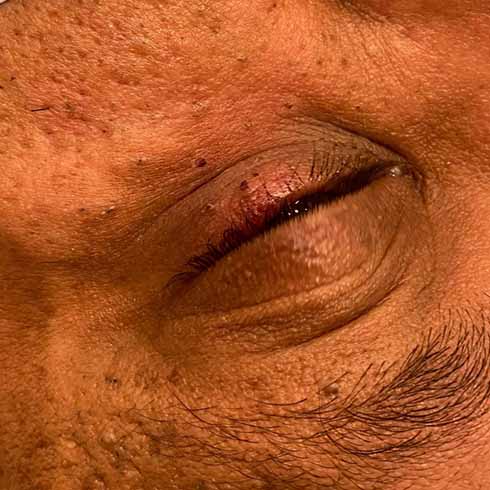 After skin tag removal