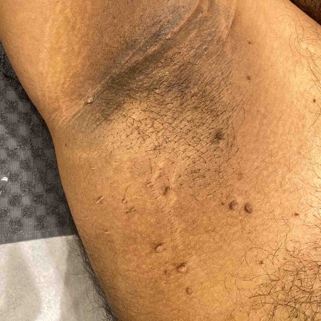 Before skin tag removal