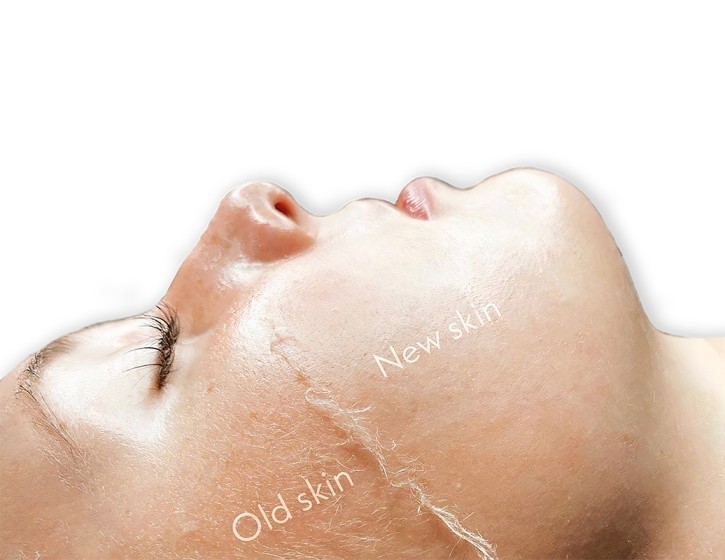 Package of 6 body pigmentation peels + 1 body hydra + 1 derma-planing (one body area only)
