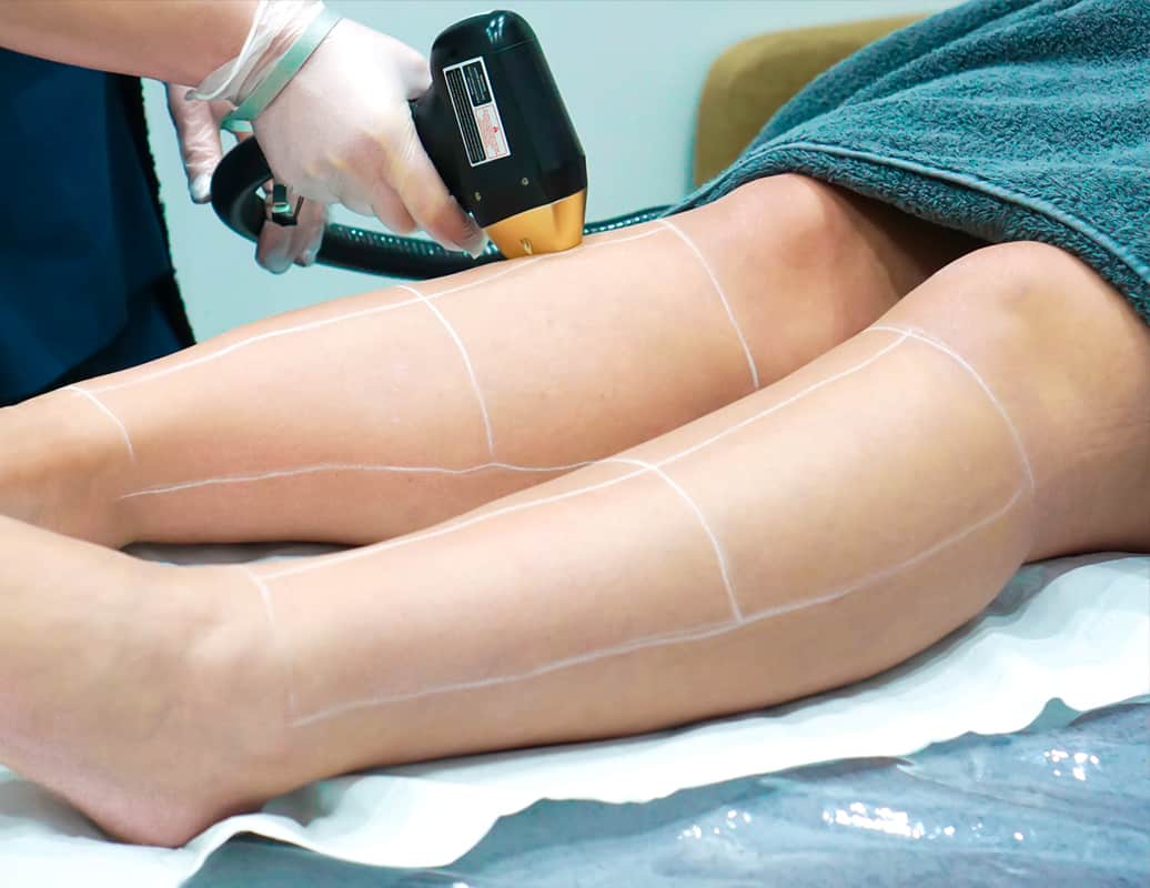 Laser Hair Removal