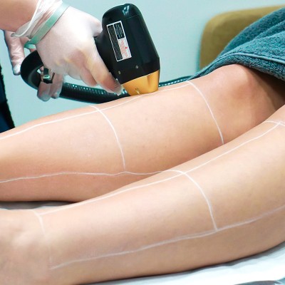 Best Laser Hair Removal London - Laser hair removal on legs