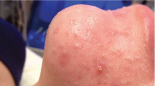 Hydra Facial London 8 Before Hydrafacial