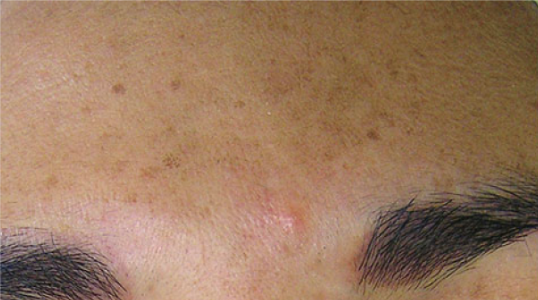 Hydra Facial London 6 Before Hydrafacial