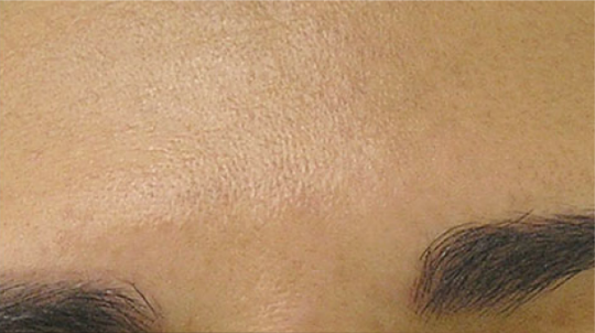 Hydra Facial London 5 After Hydrafacial