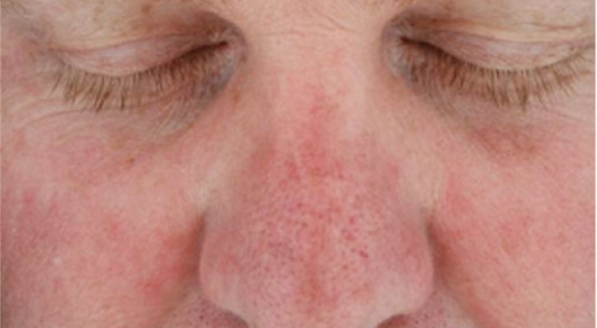 Hydra Facial London 4 Before Hydrafacial