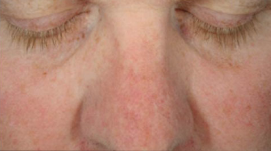 Hydra Facial London 3 After Hydrafacial