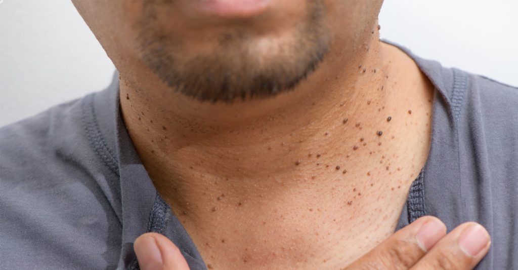 skin tag removal london