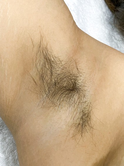 chin laser hair removal armpit