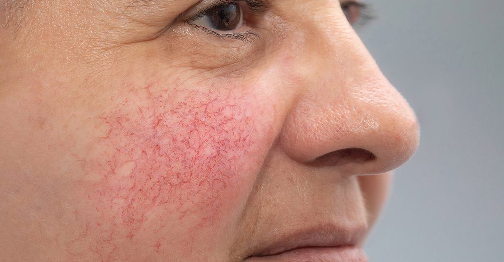 Facial Thread Veins