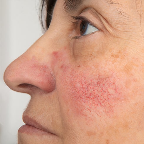 before thread vein removal