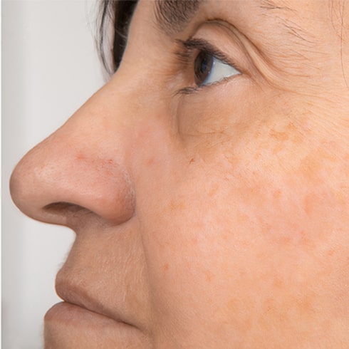 after thread vein removal