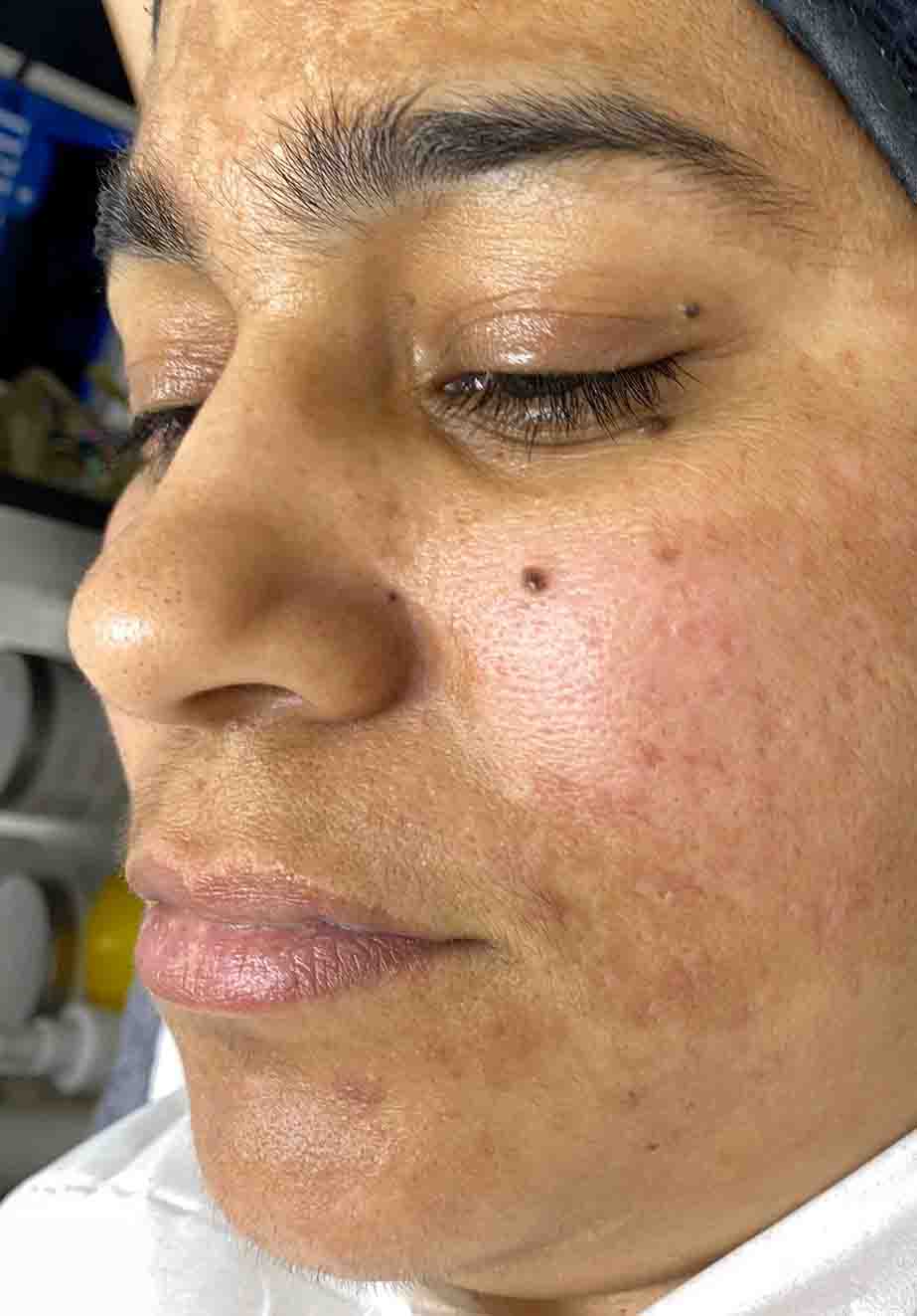 Hydra Facial London 2 face before Hydra facial