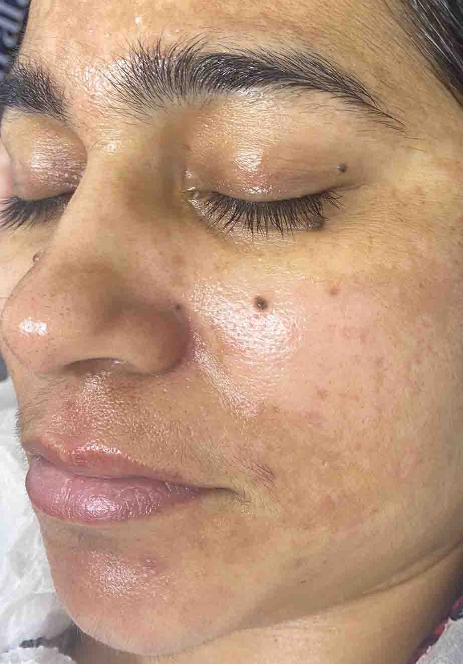 Hydra Facial London 1 face After Hydra facial