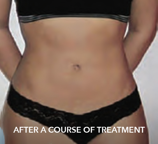 after image of fat freezing treatment
