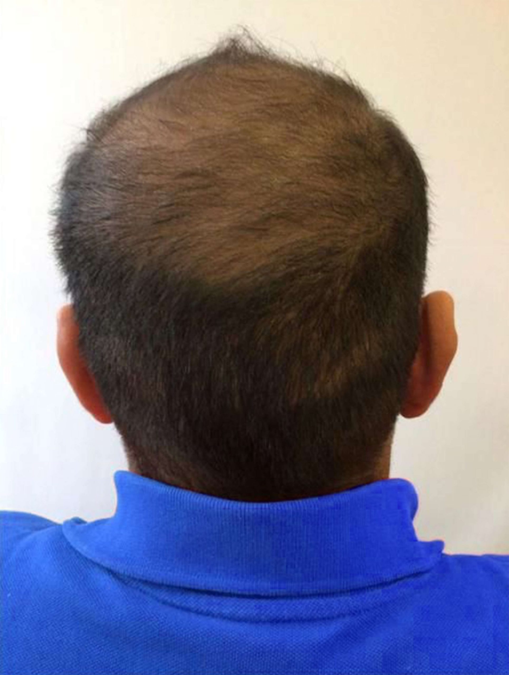 after image of hair loss treatment