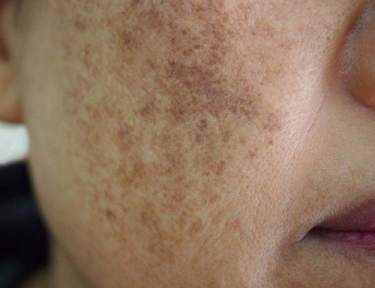 cheek Skin Pigmentation before