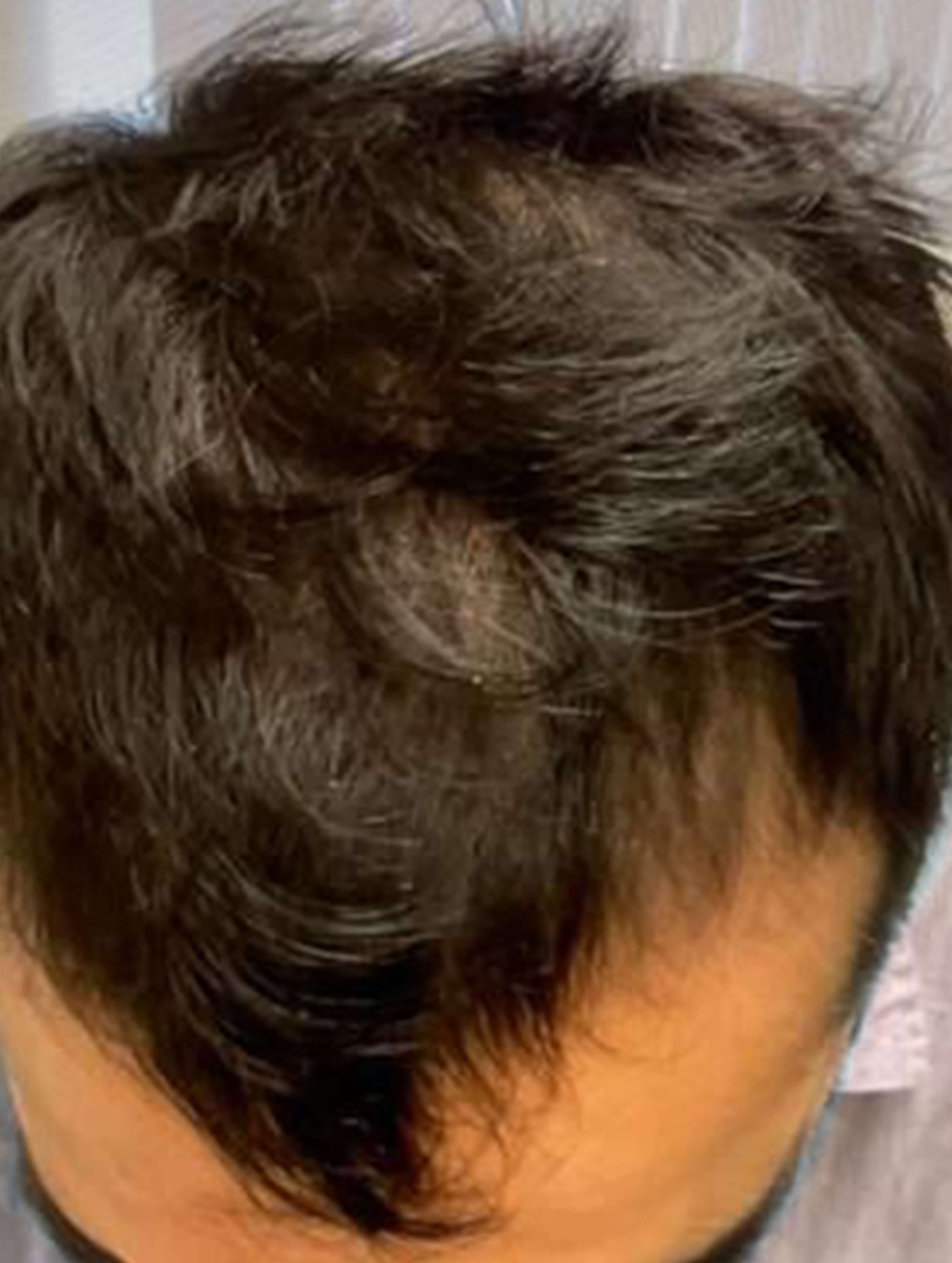 after image of hair loss treatment