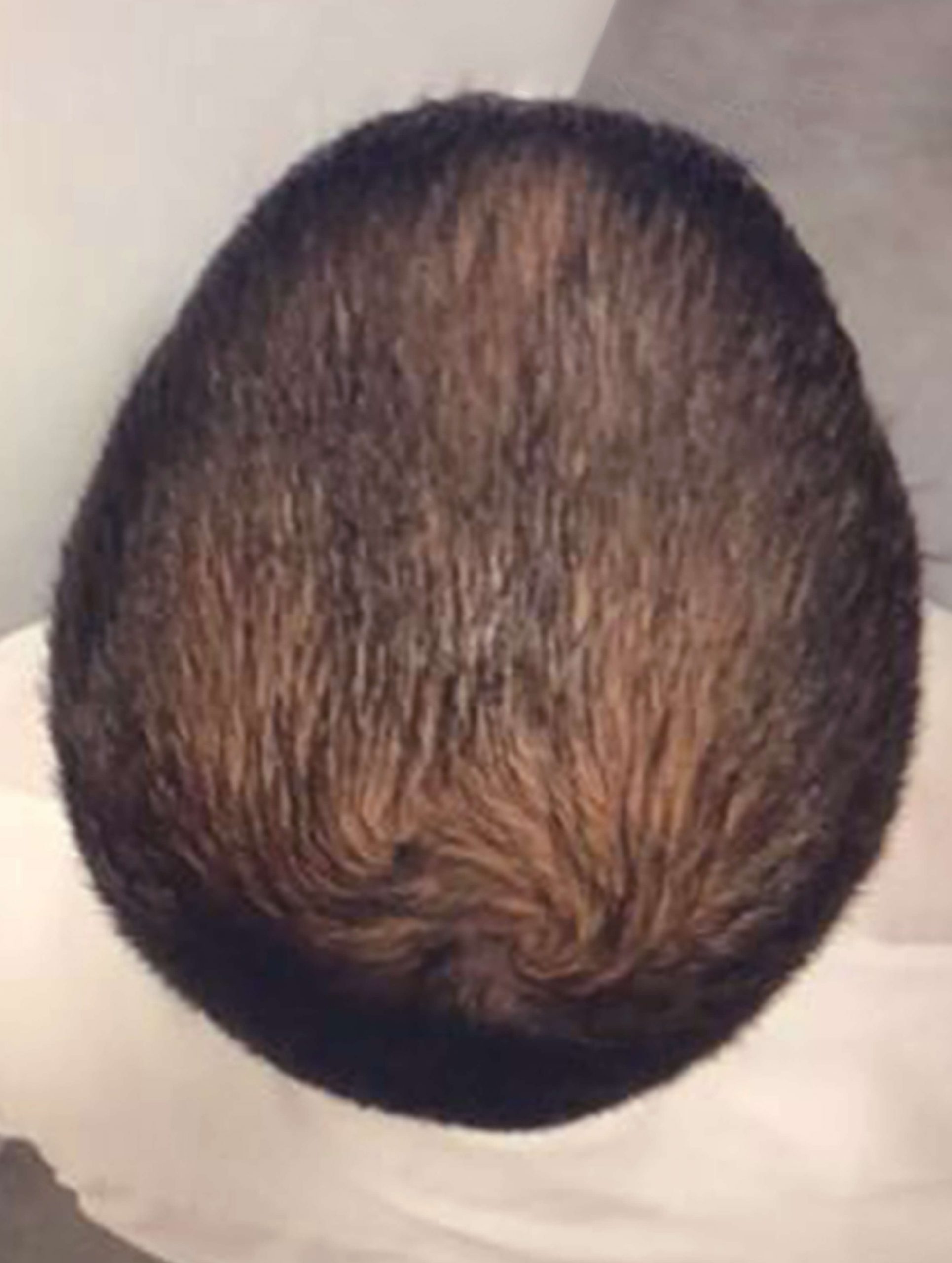 after image of prp for hair loss treatment
