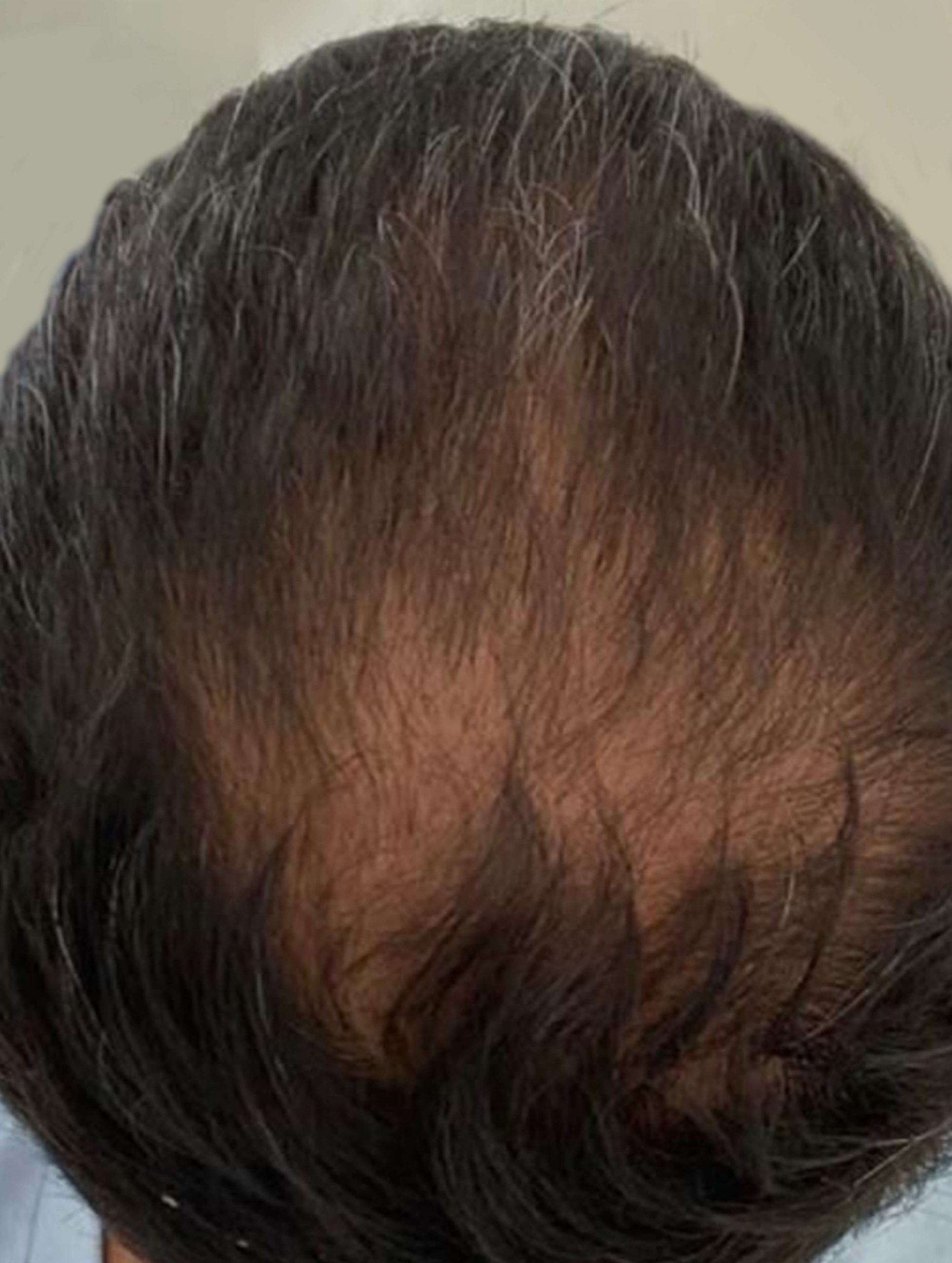 after image of prp for hair loss treatment