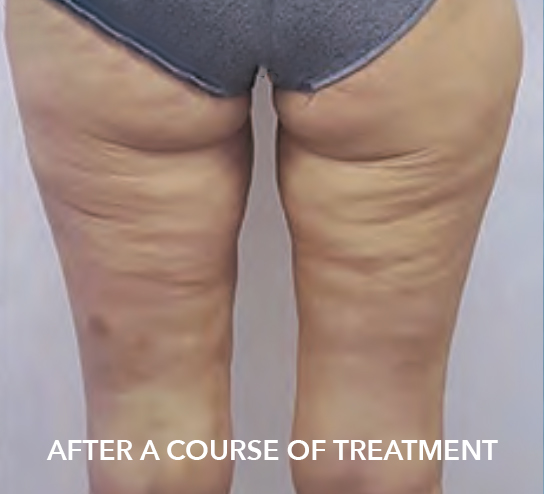 after image of fat freezing treatment