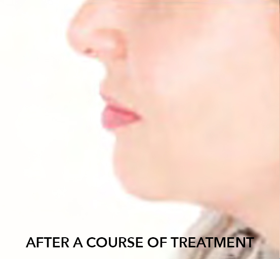 after image of double chin fat freezing treatment