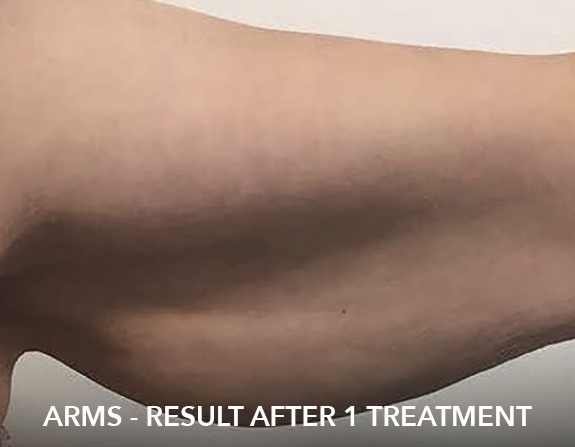 after image of fat freezing treatment