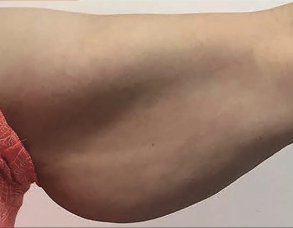 before image of fat freezing treatment