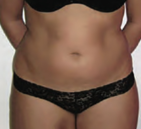 before image of fat freezing treatment