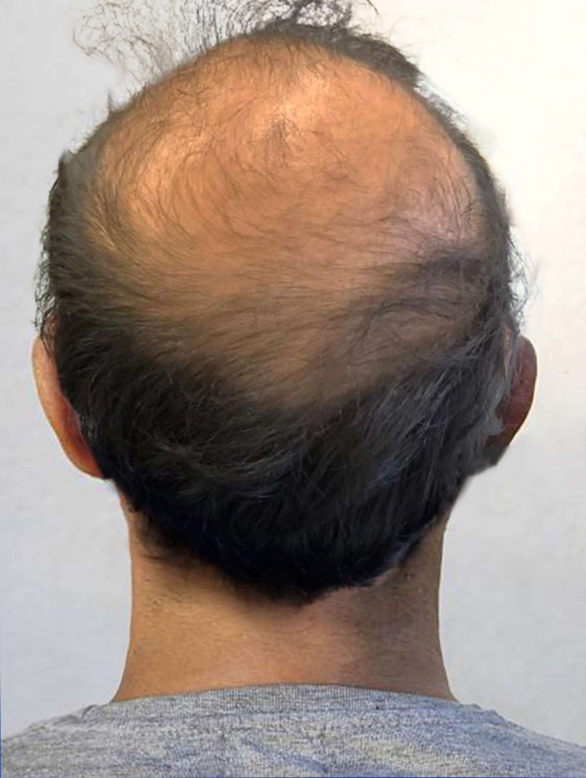 before image of prp for hair loss treatment