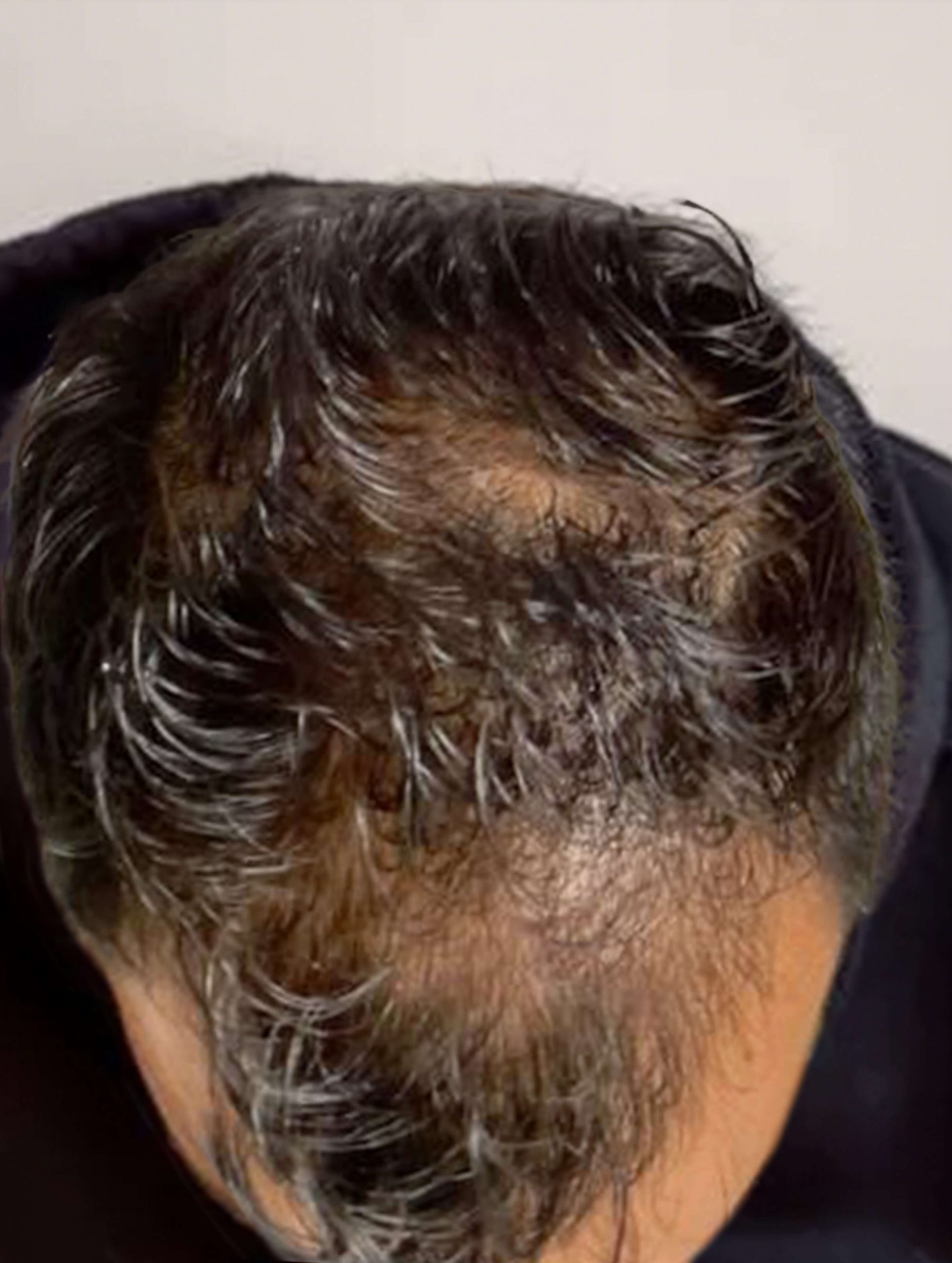 before image of hair loss treatment