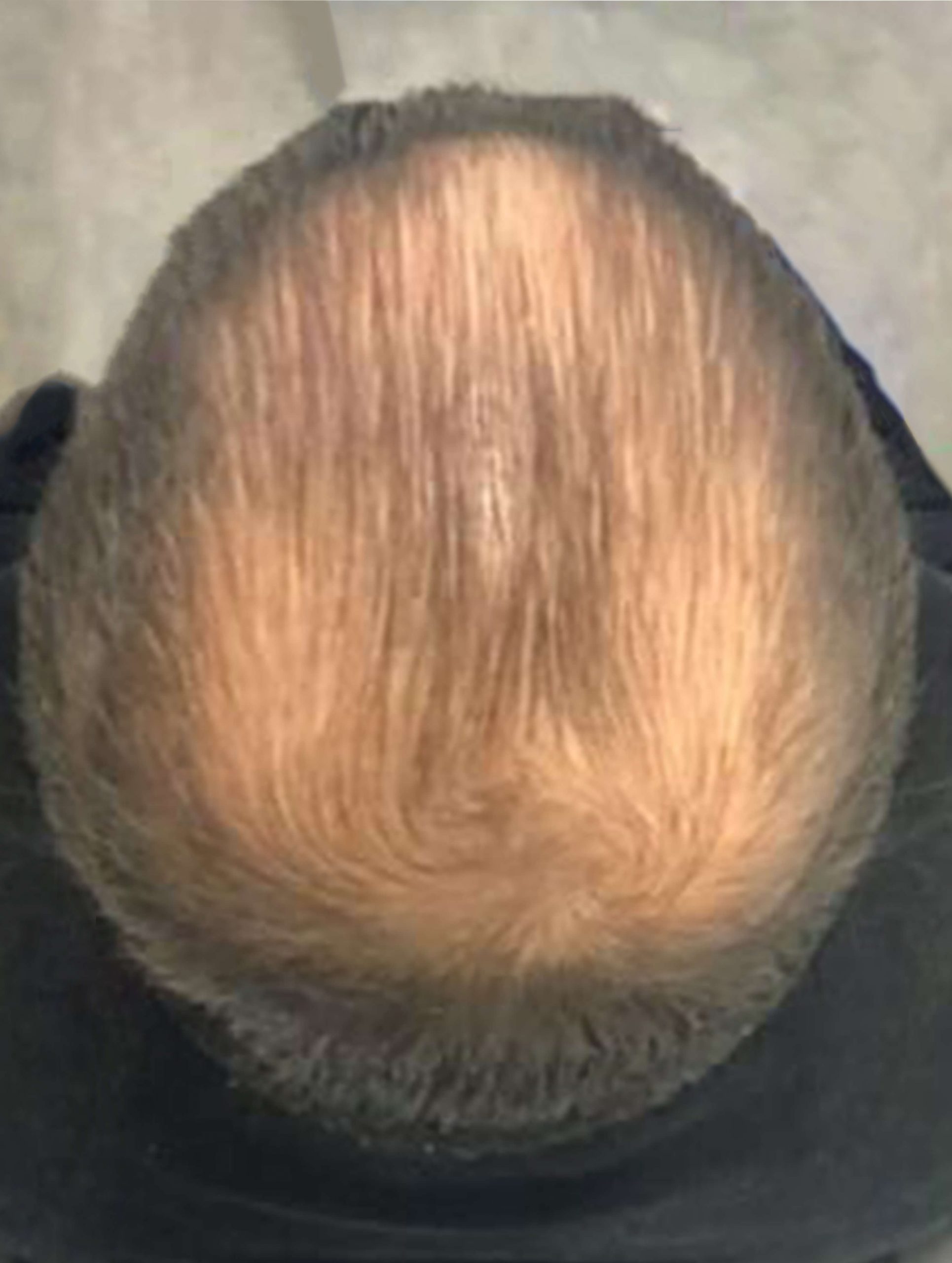 before image of prp for hair loss treatment