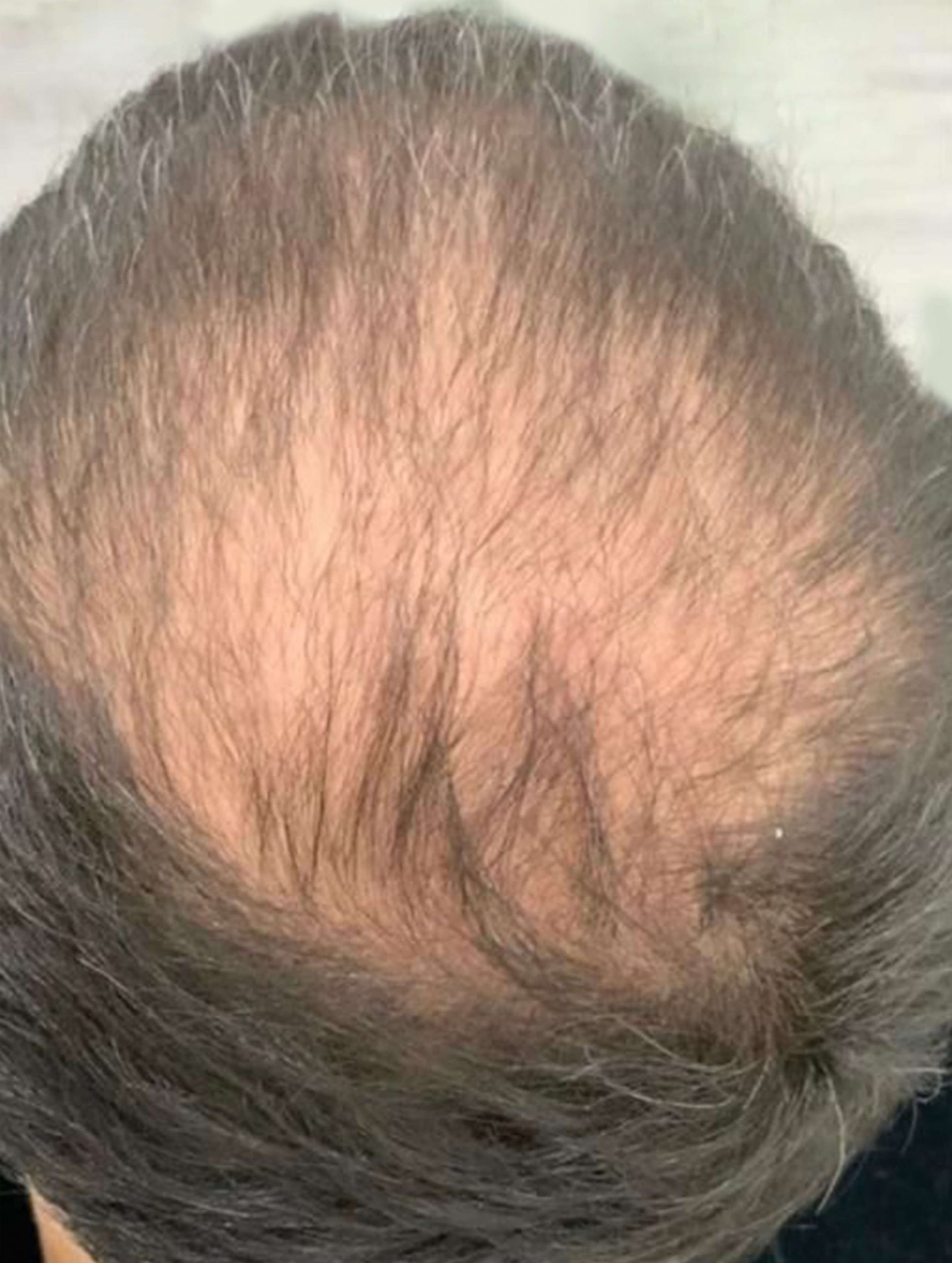 before image of hair loss treatment