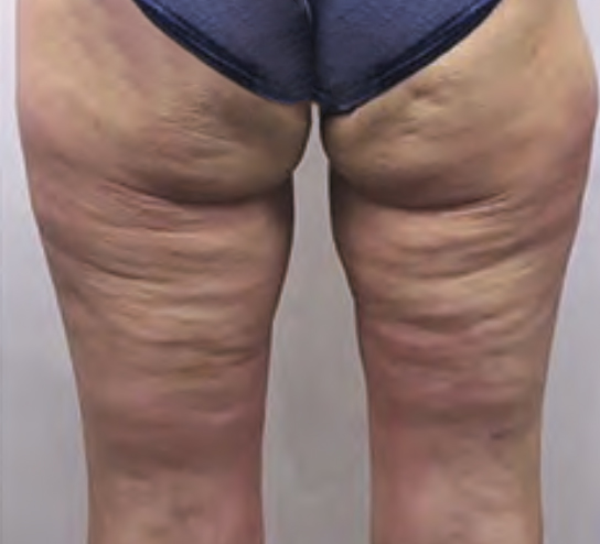 before image of cellulite fat freezing
