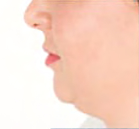 before image of double chin