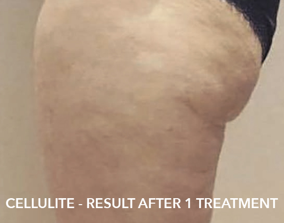 fat freezing treatment after image of cellulite