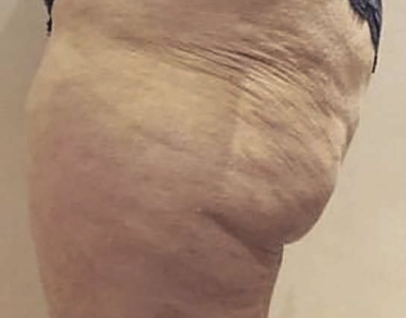 fat freezing treatment before image of cellulite