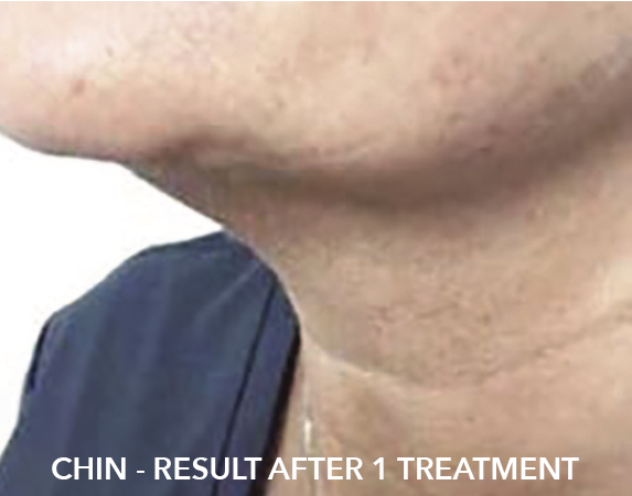 after image of double chin fat freezing treatment
