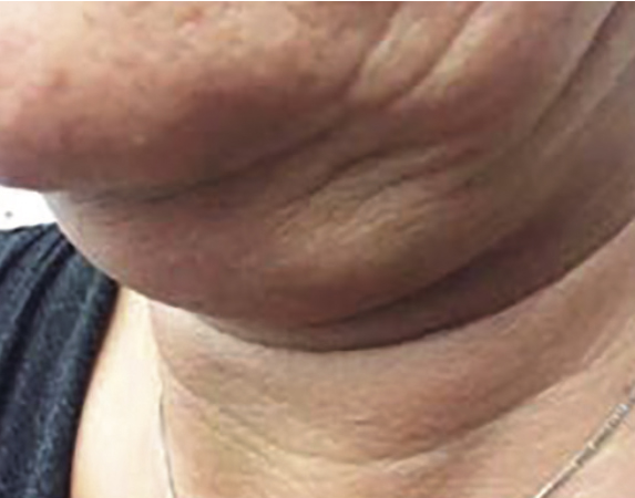 before image of double chin