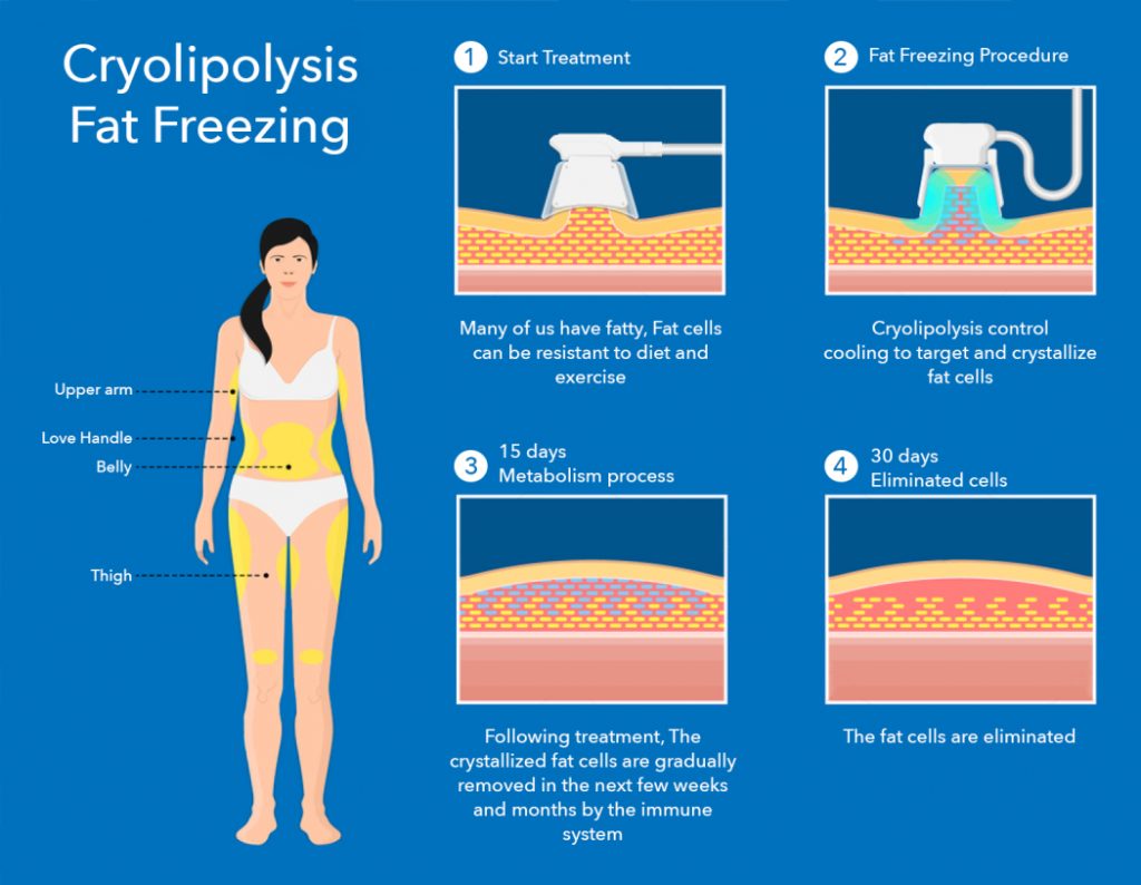 Cryolipolysis fat freezing procedure diagram
