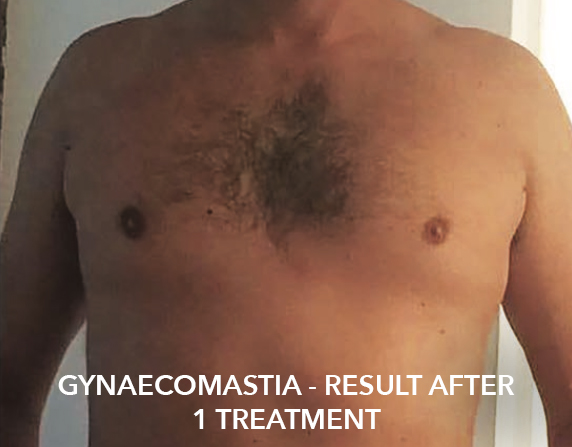 after image of gynecomastia fat freezing treatment