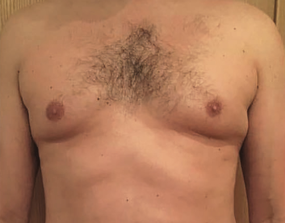before image of gynecomastia