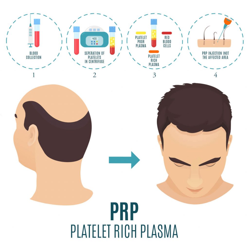 prp for hair loss treatment stages