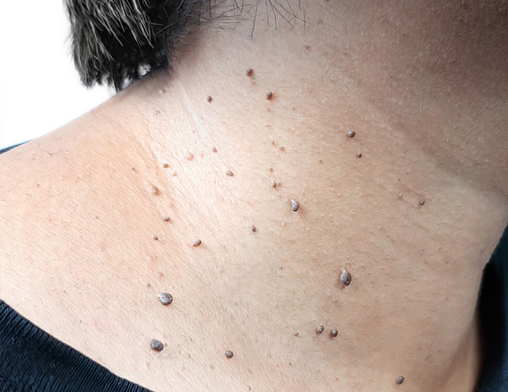 Skin Tag Removal!!! 