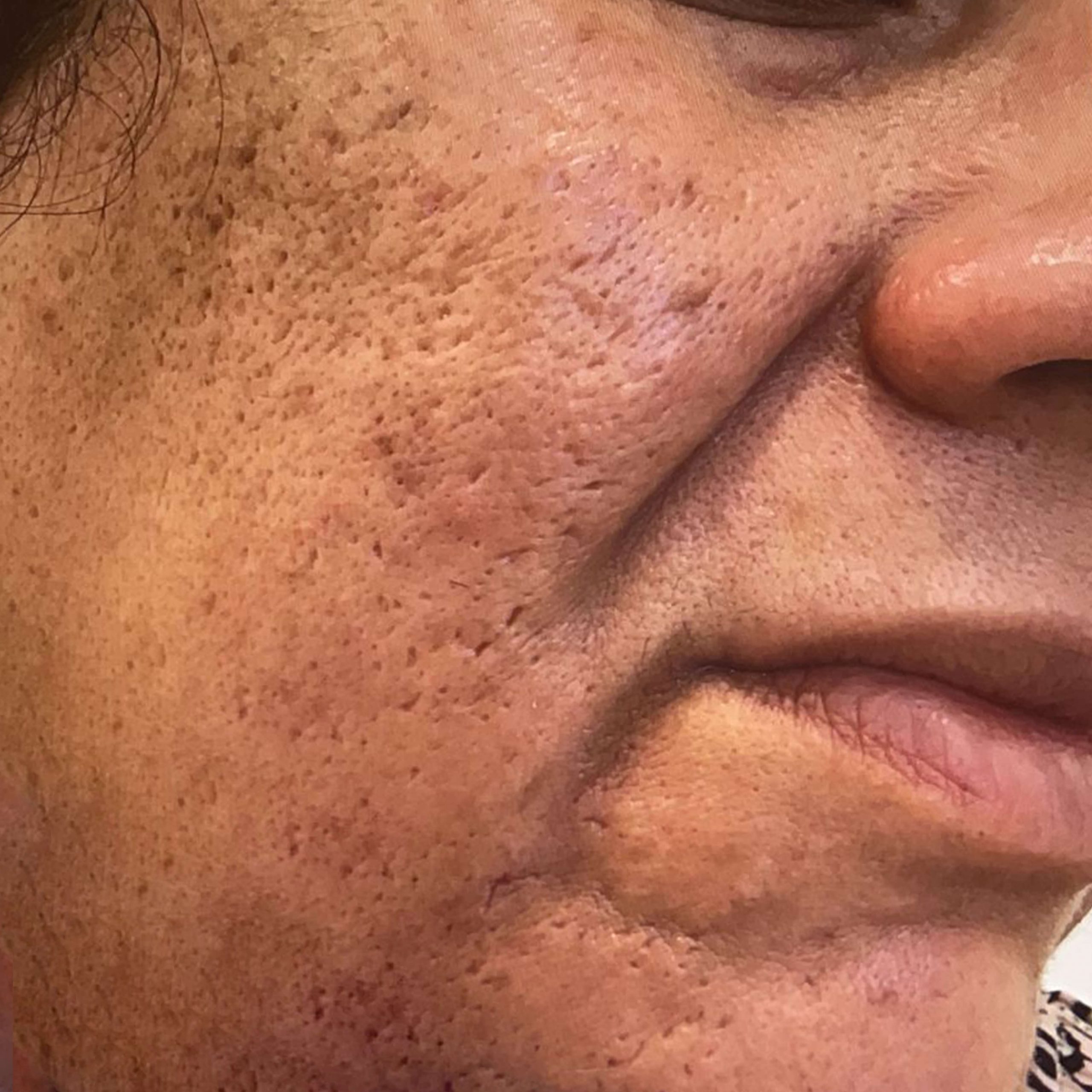 Microneedling London Before Image