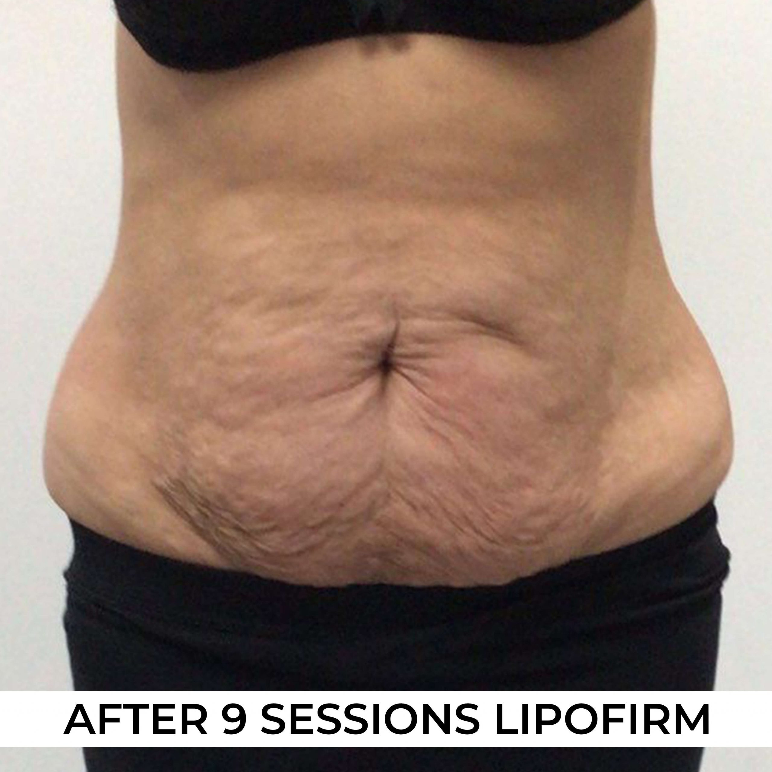 image of Lipofirm after 9 sessions