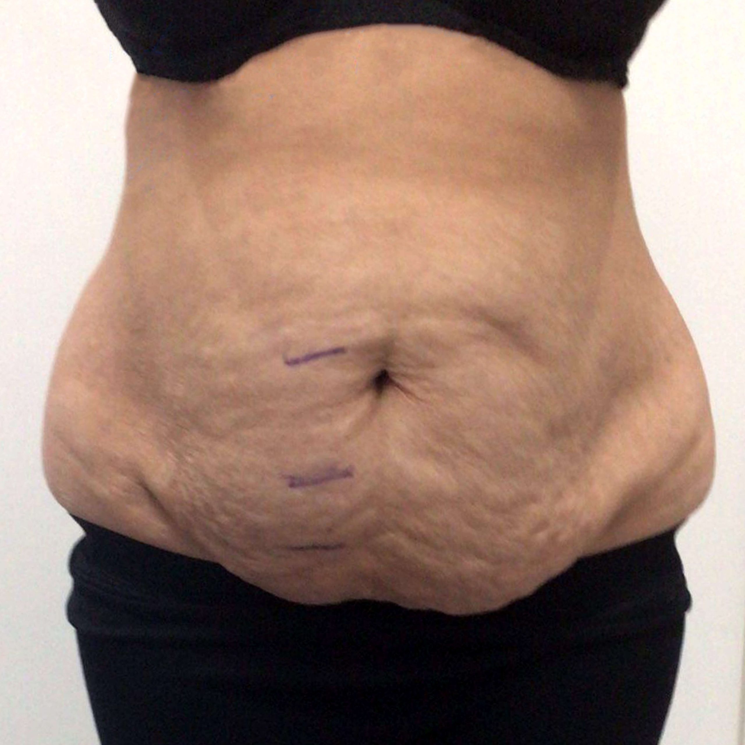 image of Lipofirm before procedure