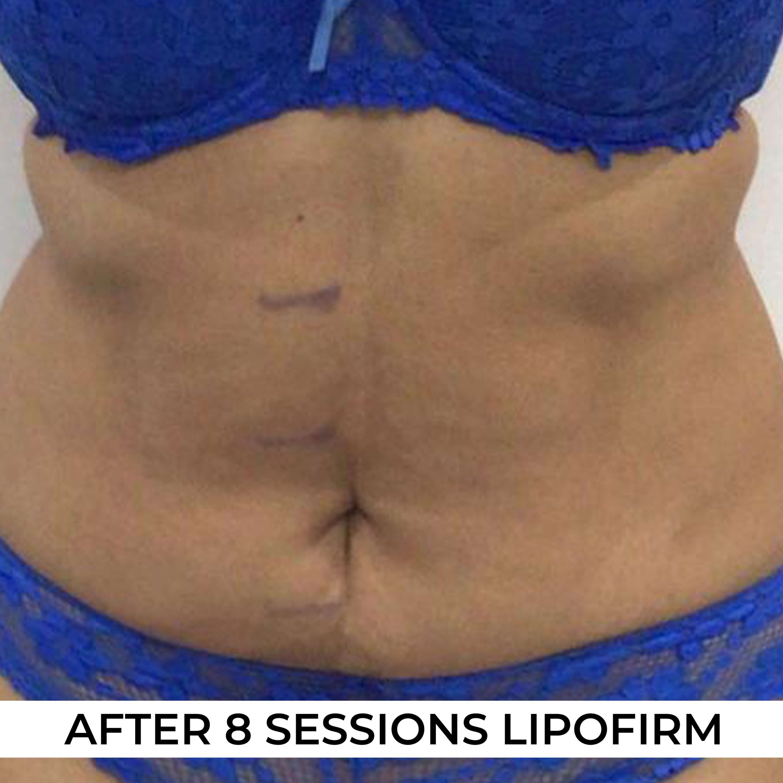 after image of Lipofirm procedure