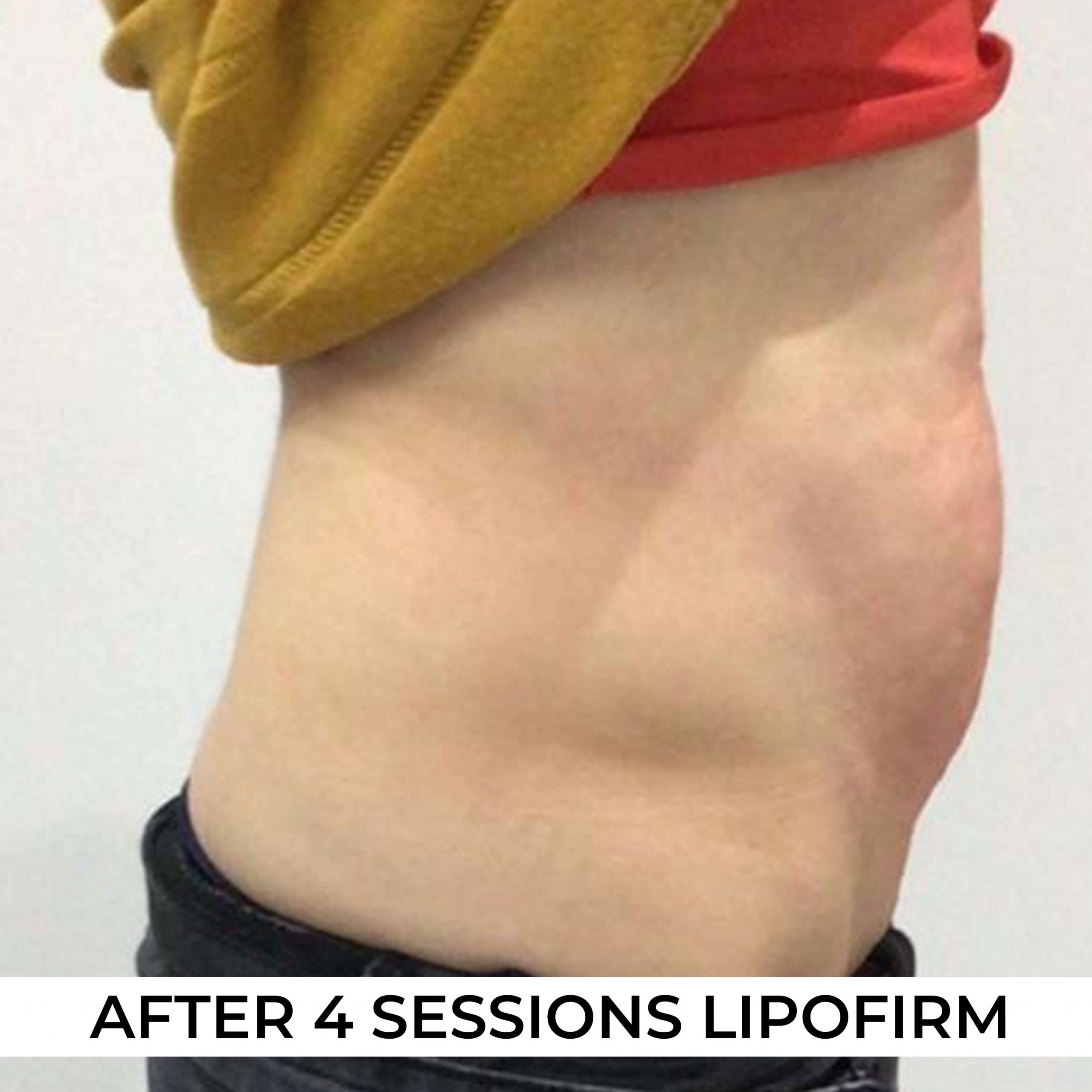 after image of Lipofirm procedure