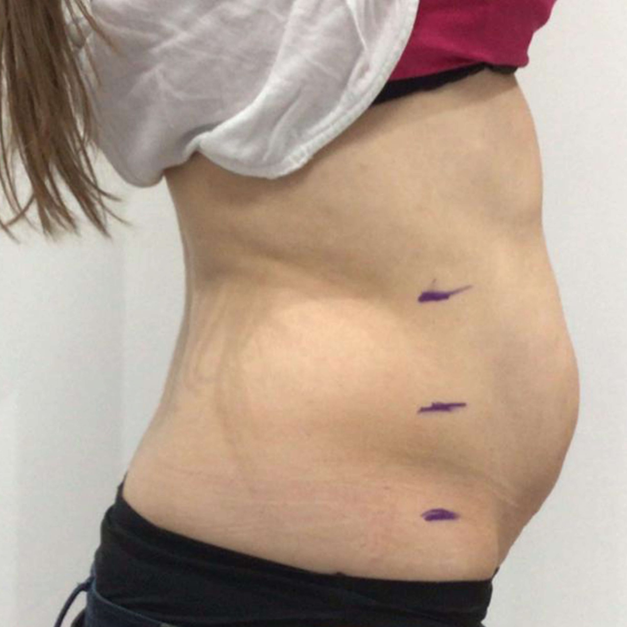 before image of Lipofirm procedure